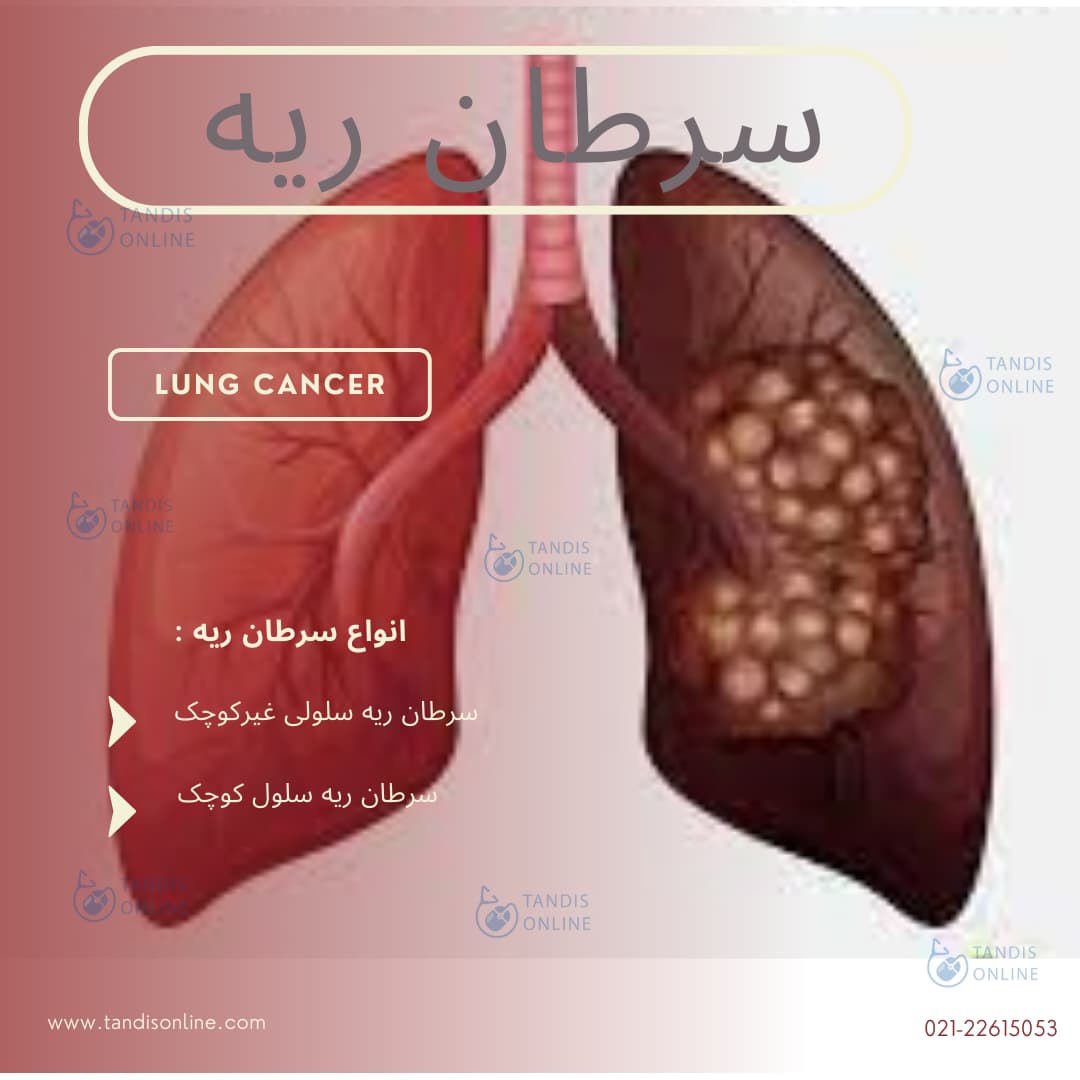 سرطان ریه